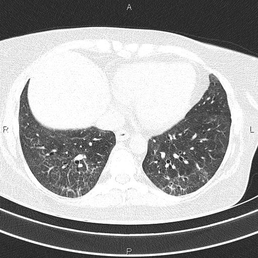 Non-specific interstitial pneumonia (Radiopaedia 83185-97567 Axial lung window 46).jpg