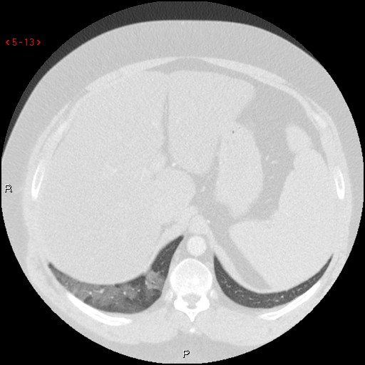File:Non-specific interstitial pneumonitis (Radiopaedia 27044-27222 Axial lung window 4).jpg