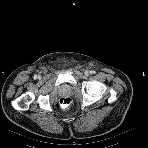 File:Non Hodgkin lymphoma in a patient with ankylosing spondylitis (Radiopaedia 84323-99621 B 64).jpg