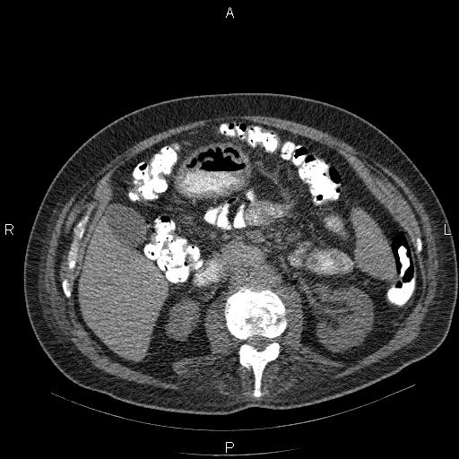File:Non Hodgkin lymphoma in a patient with ankylosing spondylitis (Radiopaedia 84323-99624 Axial non-contrast 41).jpg