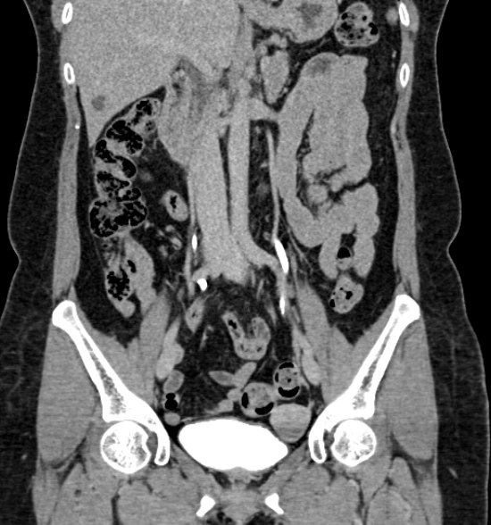 Normal CT intravenous urogram (Radiopaedia 39444-41759 A 257).jpg