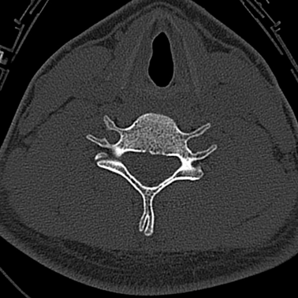 Normal CT of the cervical spine (Radiopaedia 53322-59305 Axial bone window 182).jpg