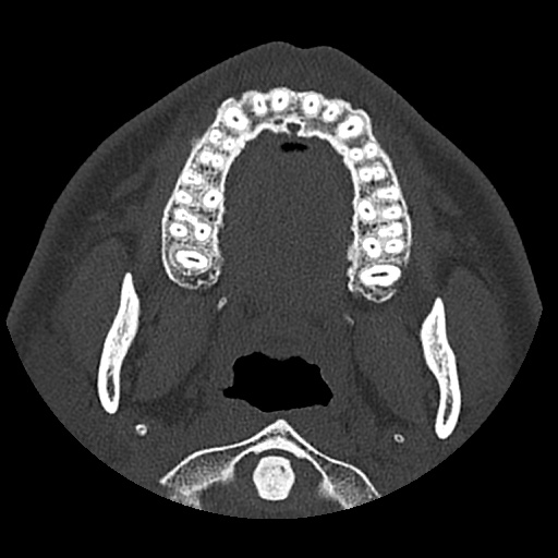 Normal CT paranasal sinuses (Radiopaedia 42286-45390 Axial bone window 103).jpg