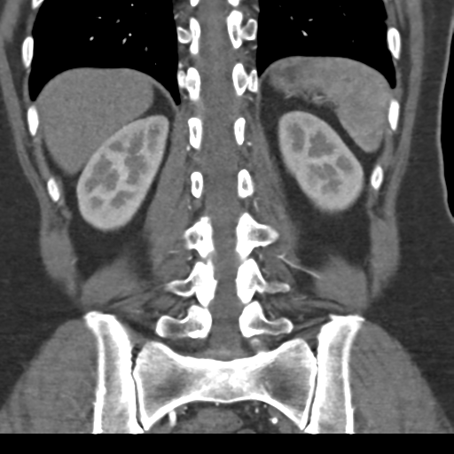 File:Normal CT renal artery angiogram (Radiopaedia 38727-40889 B 57).png
