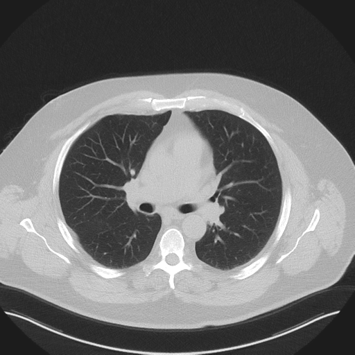 Normal HRCT (Radiopaedia 40797-43458 Axial lung window 26).png