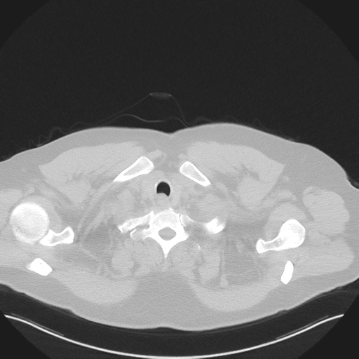 Normal HRCT (Radiopaedia 40797-43458 Axial lung window 3).png