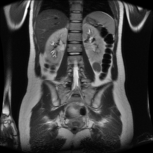 File:Normal MRI abdomen in pregnancy (Radiopaedia 88001-104541 Coronal T2 22).jpg