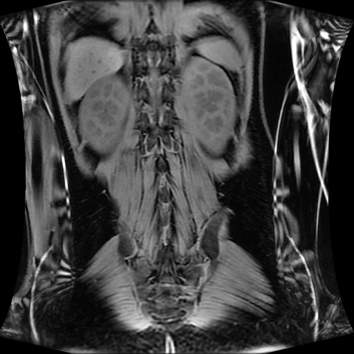 Normal MRI abdomen in pregnancy (Radiopaedia 88001-104541 M 112).jpg