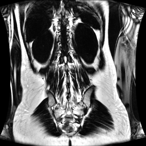 Normal MRI abdomen in pregnancy (Radiopaedia 88001-104541 N 110).jpg