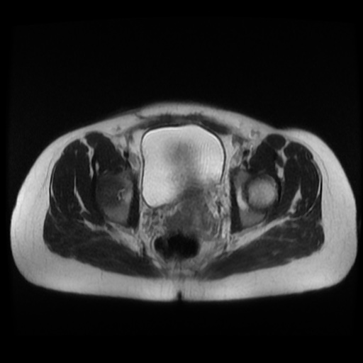 Normal MRI abdomen in pregnancy (Radiopaedia 88003-104546 Axial T2 44).jpg