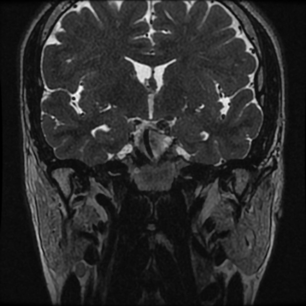Normal MRI petrous (Radiopaedia 91317-108949 Coronal T2 18).jpg