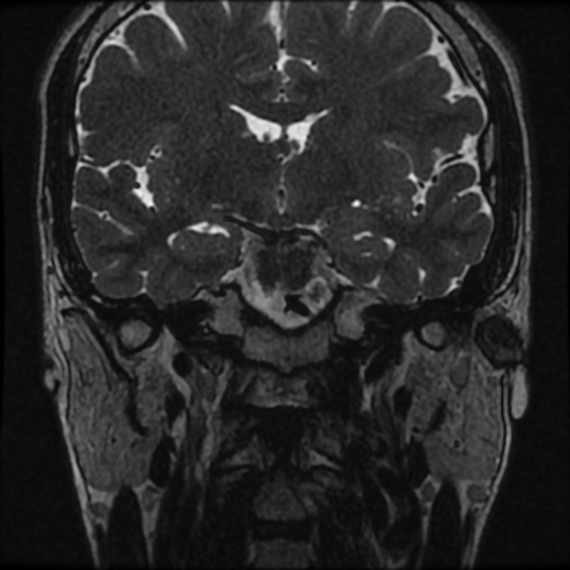 Normal MRI petrous (Radiopaedia 91317-108949 Coronal T2 26).jpg