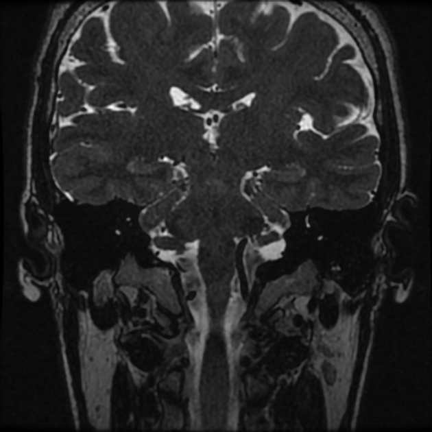 Normal MRI petrous (Radiopaedia 91317-108949 Coronal T2 62).jpg