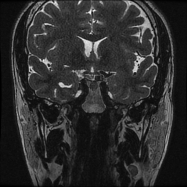 Normal MRI petrous (Radiopaedia 91317-108949 Coronal T2 7).jpg