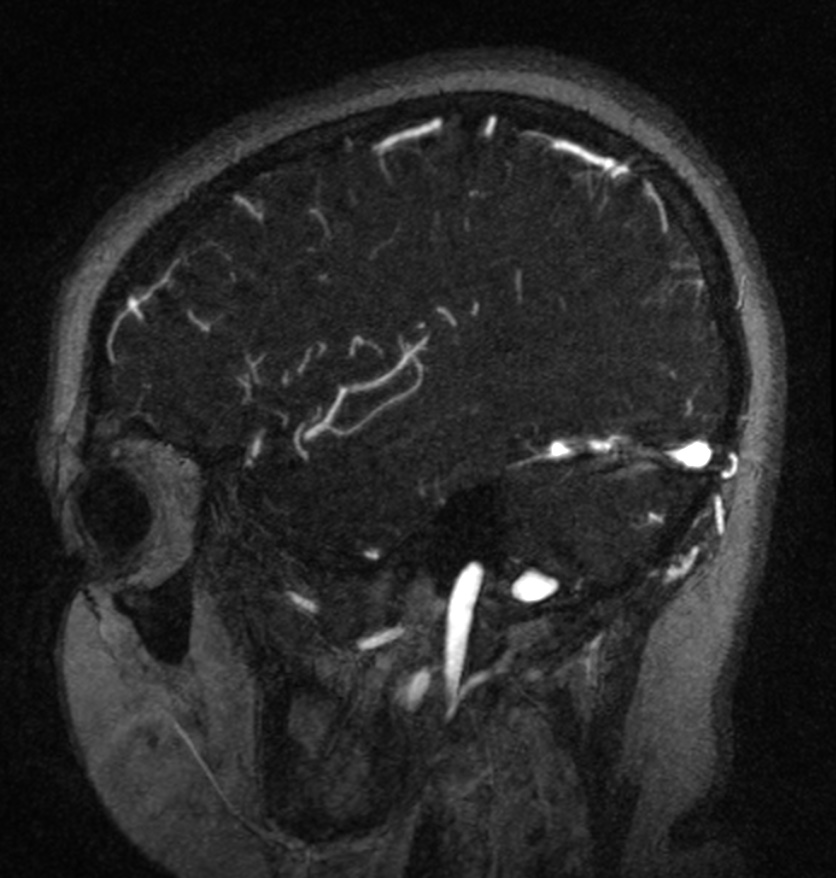 Normal brain MRI and venogram (Radiopaedia 39554-41862 Sagittal MRV 51).jpg