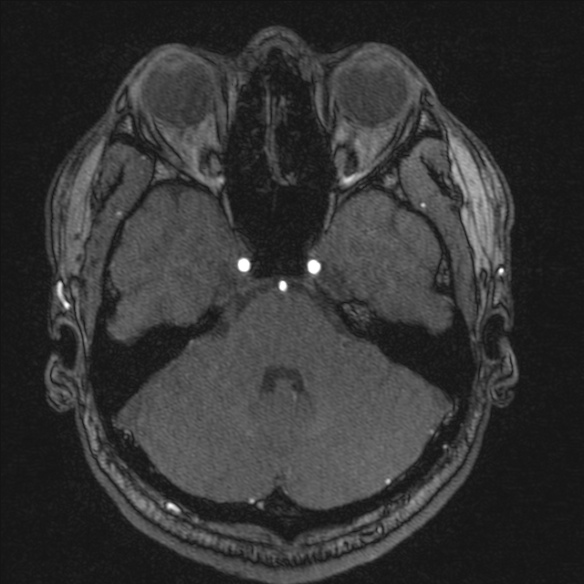 Normal brain MRI including MRA (Radiopaedia 48748-53763 Axial MRA 53).jpg