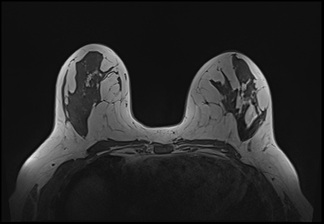 File:Normal breast MRI - dense breasts (Radiopaedia 80454-93850 Axial T1 107).jpg