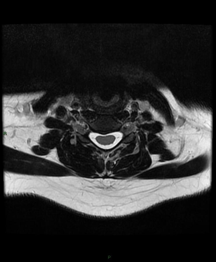 Normal cervical spine MRI (Radiopaedia 80146-93454 Axial T2 61).jpg