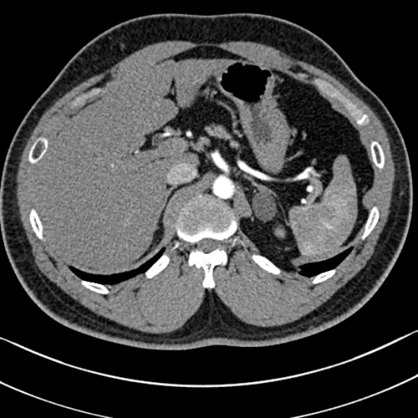 Normal kidneys on 4-phase CT study (Radiopaedia 25889-26038 B 2).jpg