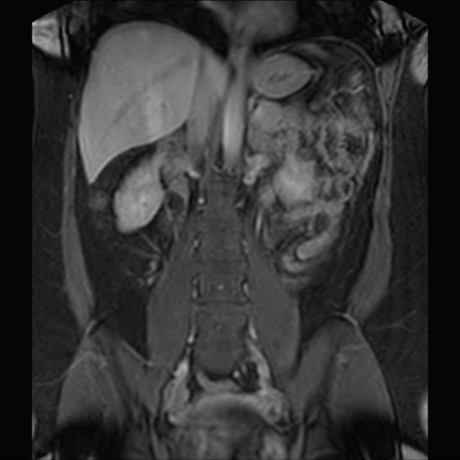 Normal liver MRI with Gadolinium (Radiopaedia 58913-66163 P 50).jpg