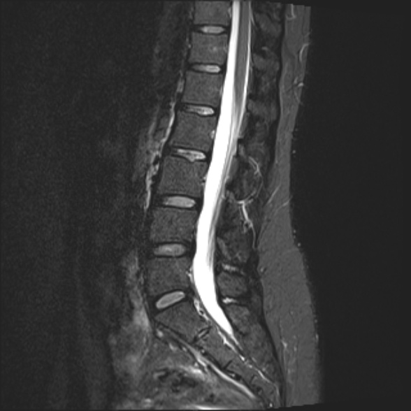 File:Normal lumbar spine MRI- 3 T (Radiopaedia 53280-59250 Sagittal STIR 13).jpg