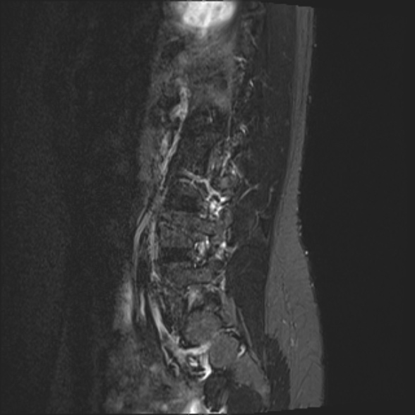 File:Normal lumbar spine MRI- 3 T (Radiopaedia 53280-59250 Sagittal STIR 20).jpg