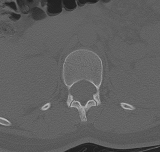 File:Normal lumbosacral CT (Radiopaedia 37923-39867 Axial bone window 28).png