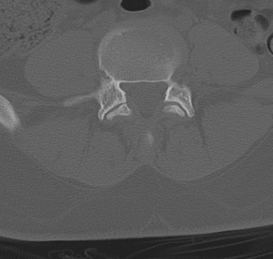 File:Normal lumbosacral CT (Radiopaedia 37923-39867 Axial bone window 70).png