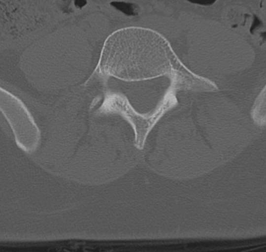File:Normal lumbosacral CT (Radiopaedia 37923-39867 Axial bone window 74).png