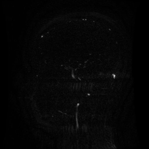 Normal noncontrast MR venography (Radiopaedia 87578-103957 A 105).jpg
