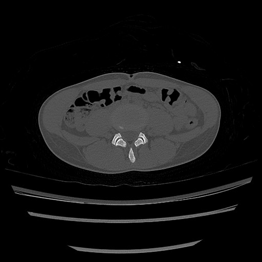 Normal pelvis CT (Radiopaedia 51471-57236 Axial bone window 1).jpg