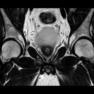 File:Normal prostate (MRI) (Radiopaedia 29986-30535 Coronal T2 8).jpg