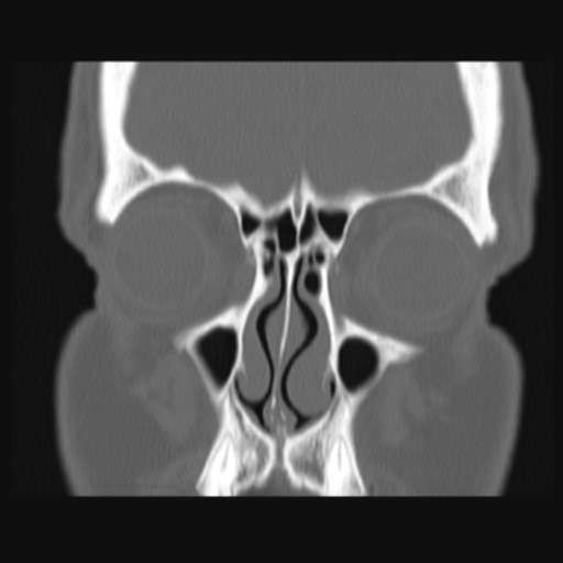Normal sinus CT (annotated) (Radiopaedia 78917-91810 Coronal bone window 20).jpg