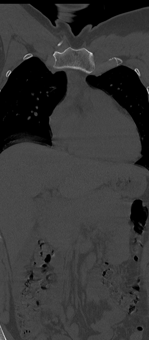 Normal thoracolumbar spine (Radiopaedia 43822-47309 Coronal bone window 8).png