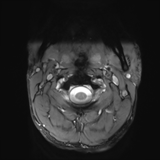 File:Normal trauma cervical spine (Radiopaedia 41017-43762 Axial T2 2).png