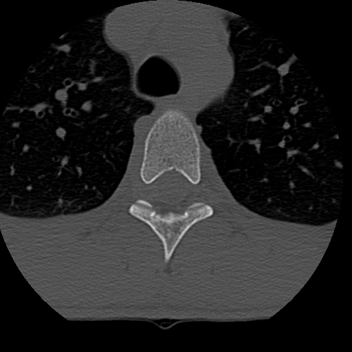 File:Normal trauma spine imaging (age 16) (Radiopaedia 45335-49358 Axial bone window 102).jpg