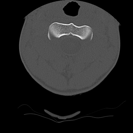 Normal trauma spine imaging (age 16) (Radiopaedia 45335-49358 Axial bone window 17).jpg