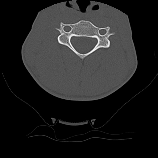 Normal trauma spine imaging (age 16) (Radiopaedia 45335-49358 Axial bone window 37).jpg
