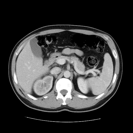 File:Obstructing ureteric calculus (Radiopaedia 18615-18514 B 18).jpg