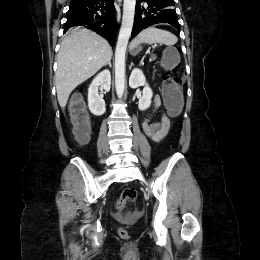Obstructive distal colonic adenocarcinoma causing cecal perforation (Radiopaedia 86830-102989 C 117).jpg