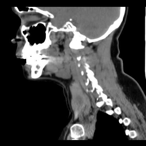 File:Obstructive sleep apnea (CT evaluation) (Radiopaedia 24304-24582 C 27).jpg