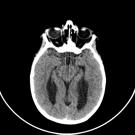 Occipital encephalocele (Radiopaedia 87339-103636 Axial non-contrast 36).jpg