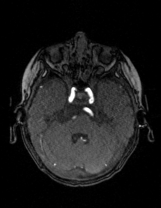 Occipital horn syndrome (Radiopaedia 14255-14129 MRA 43).jpg