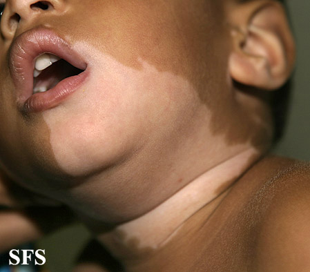 File:Vitiligo (Dermatology Atlas 39).jpg
