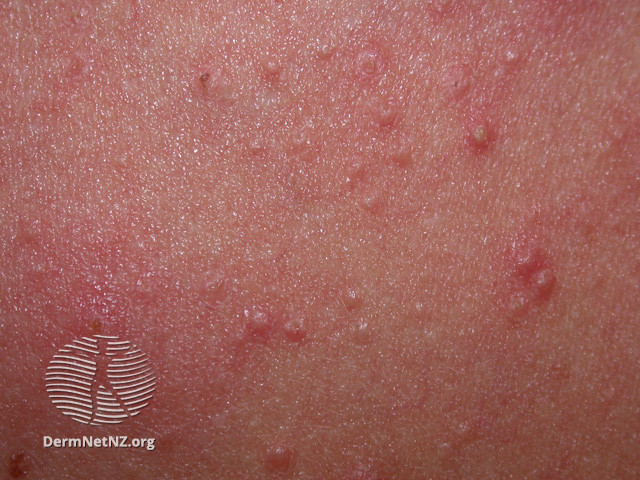 File:(DermNet NZ acne-folliculitis-2658).jpg