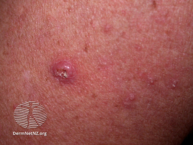 File:(DermNet NZ lesions-keratoacanthoma-2999).jpg