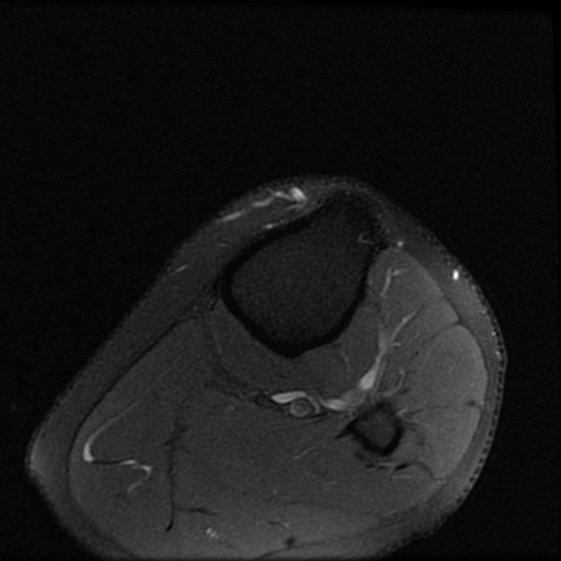 File:ACL and meniscal tears (Radiopaedia 79604-92797 Axial PD fat sat 28).jpg