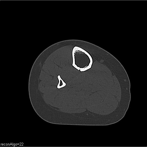 File:ACL avulsion fracture (Radiopaedia 33833-34994 Axial bone window 38).jpg
