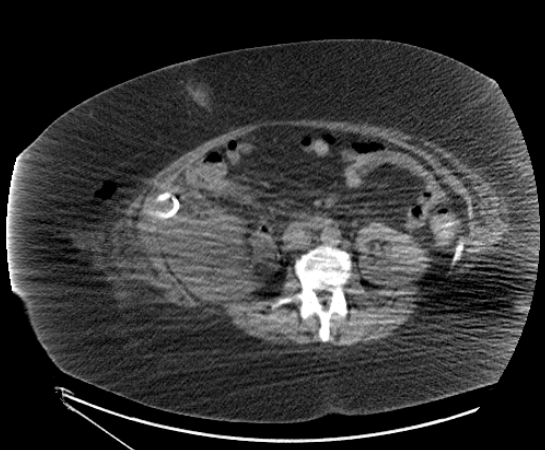 File:Abdominal abscess - pre and post percutaneous drainage (Radiopaedia 60209-82793 Axial 1).png