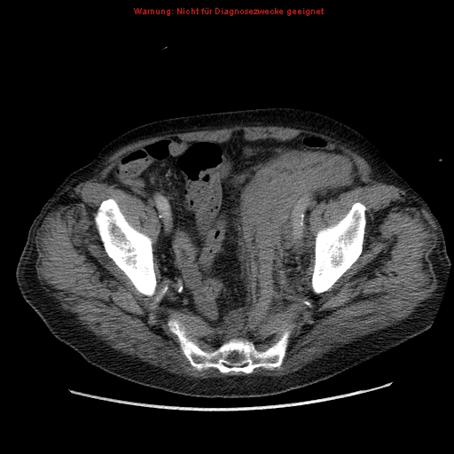 Abdominal aortic aneurysm- extremely large, ruptured (Radiopaedia 19882-19921 Axial C+ arterial phase 66).jpg